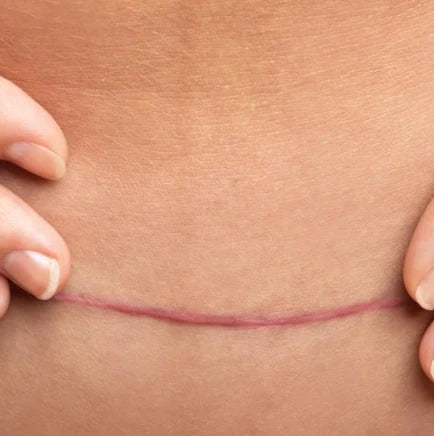 What Is the Best Gel for C-Section Scars in Australia?
