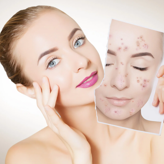 A woman after acne cream treatment