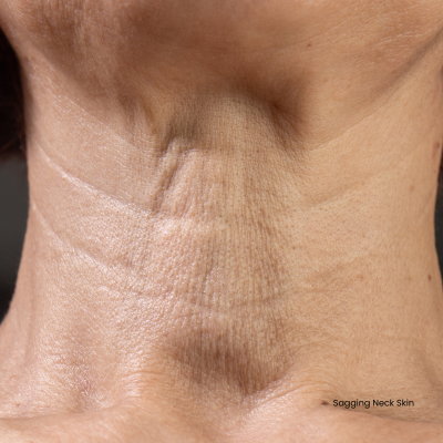 Understanding loss of skin elasticity