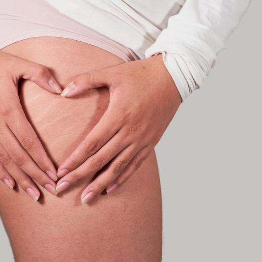 What Makes Genova Stretch Mark Cream the Best Choice for Smoother, Resilient Skin?