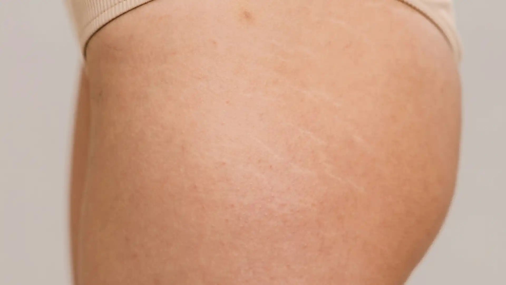 How to Get Rid of Stretch Marks: The Ultimate Treatment Guide for 2025