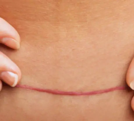 A Hypertrophic Scar