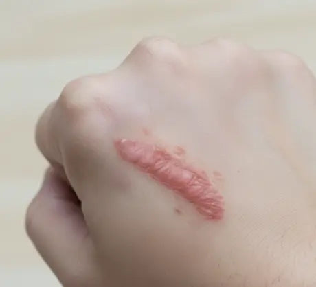 A Keloid Scar on a Hand
