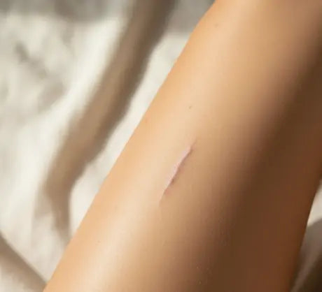 A scar on a womans leg