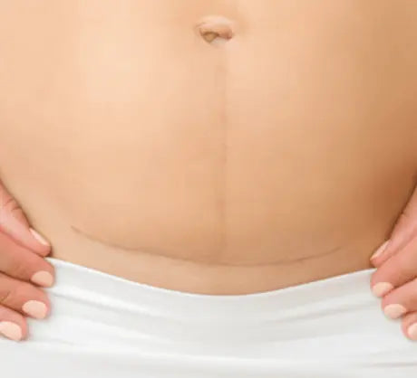 C-Section-Silicone-Scar-Gel-A-Complete-Guide-to-Scar-Healing Genova Skincare