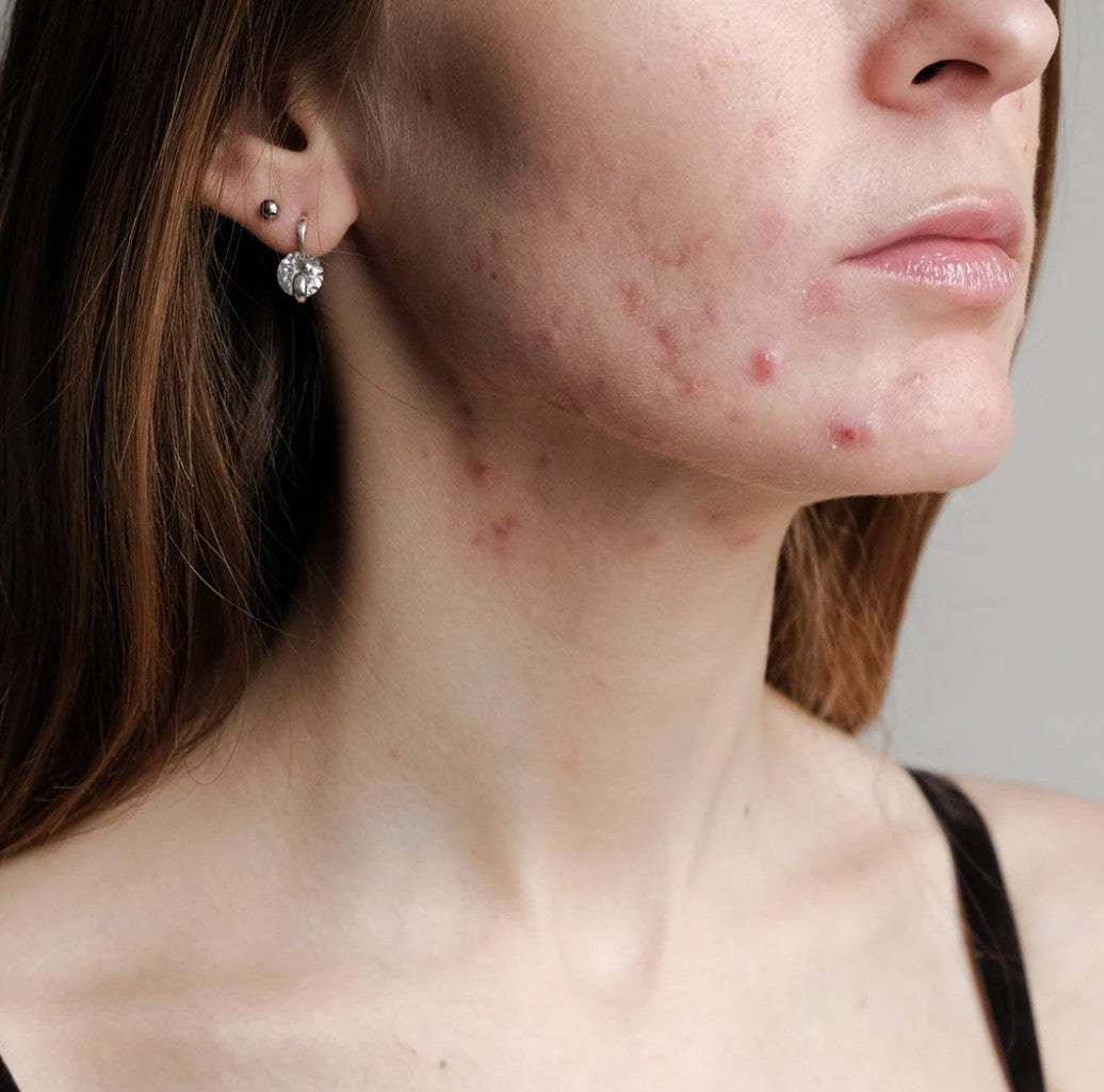 A woman with menopausal acne