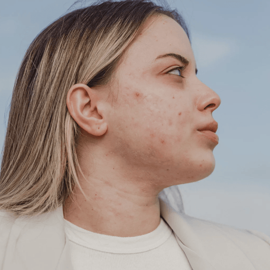 Woman over 45 deciding whether hormonal acne needs a doctor or home care