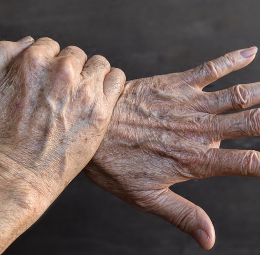 Age Spots Hands