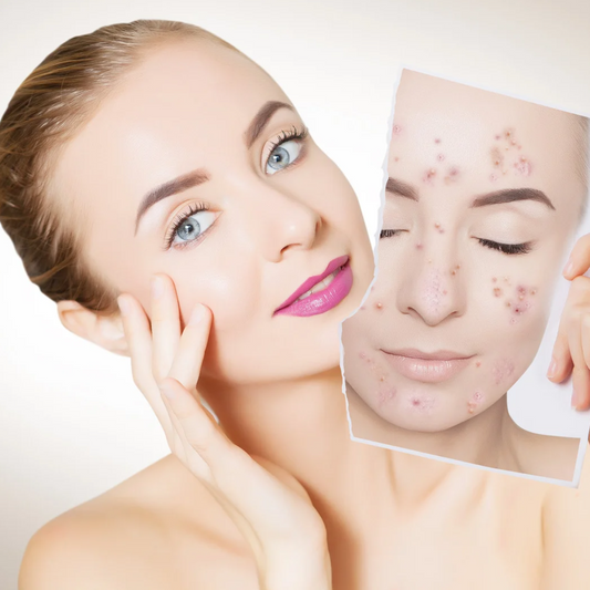 A woman with acne removed