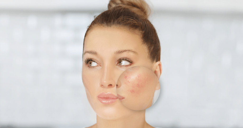 Facial redness across the cheeks of menopausal skin
