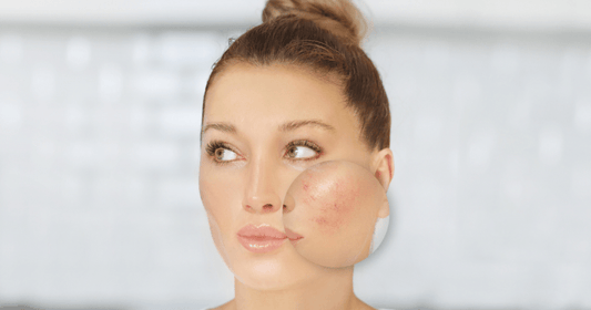 Facial redness across the cheeks of menopausal skin