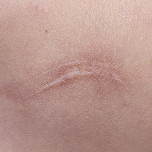 Keloid Image