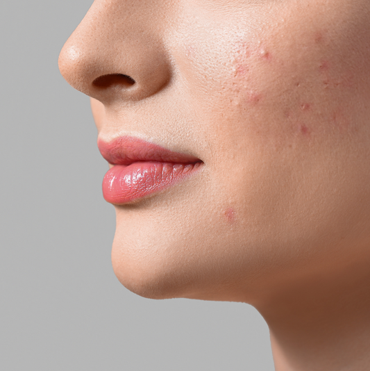 mature woman acne face breakouts