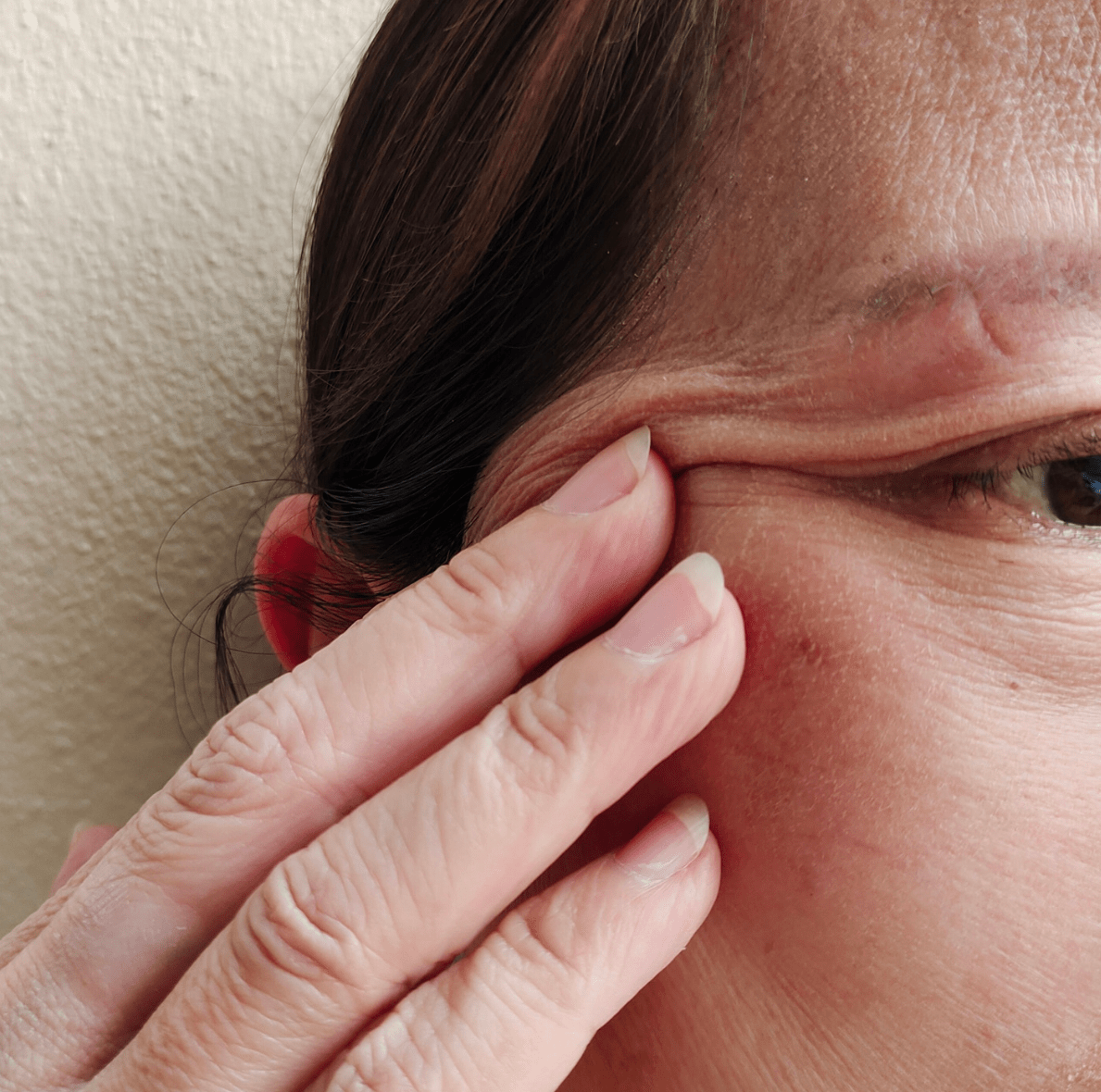 Woman over 45 with hormonal pimples on the chin after starting menopause hormone therapy