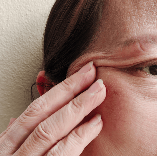 Woman over 45 with hormonal pimples on the chin after starting menopause hormone therapy