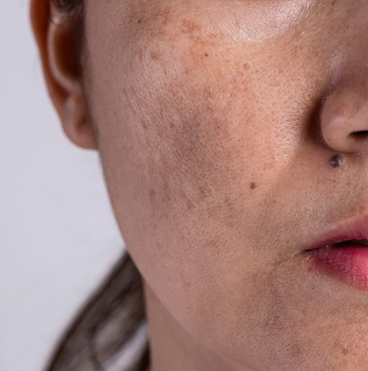 A woman with Melasma