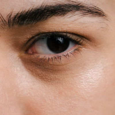 Dark circles around the eye area