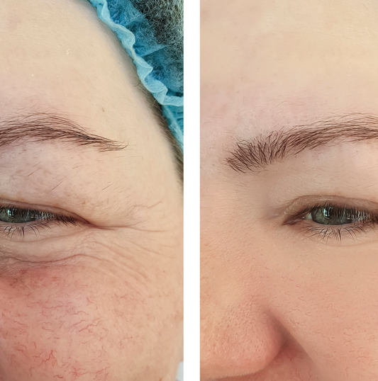 A woman with rosacea - before and after