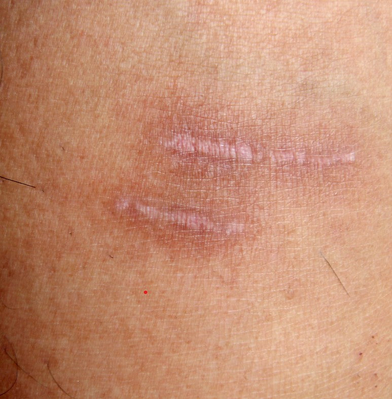Understanding Scar Treatment: A Complete Guide to Healing and Fading