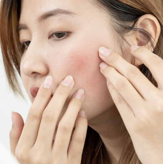 Relieving Rosacea with Genova Skincare