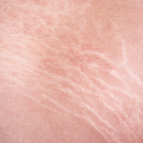 Stretch Marks 1