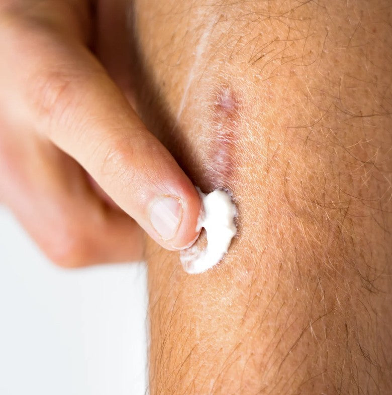 Treating a scar on a leg