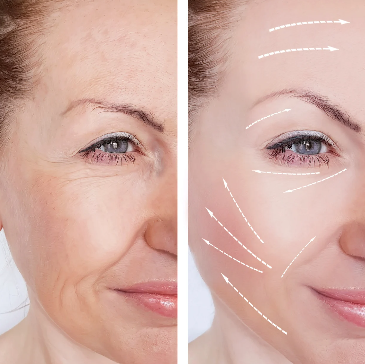 A woman with wrinkles before and after treatment