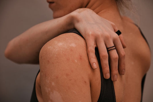 A woman itching her skin