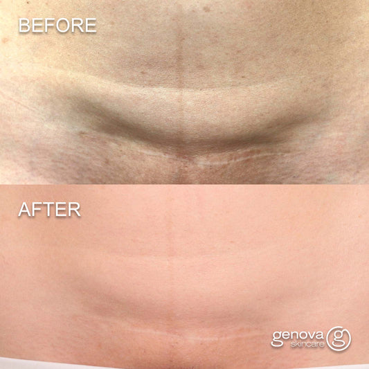Before and after of an abdominal scar over several weeks of silicone scar gel use, showing gradual fading