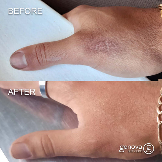 Before and after using silicone scar gel on a hand, showing a flatter, less red scar after consistent use