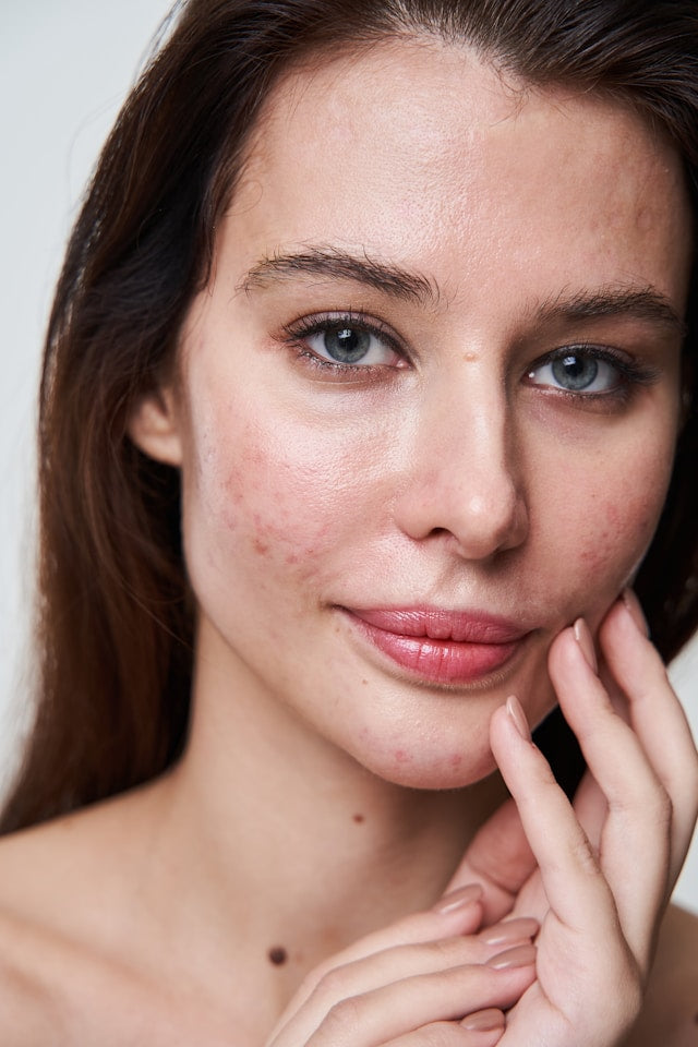 Get rid of blemishes with Genova Skincare