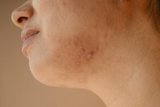 A mature woman with acne