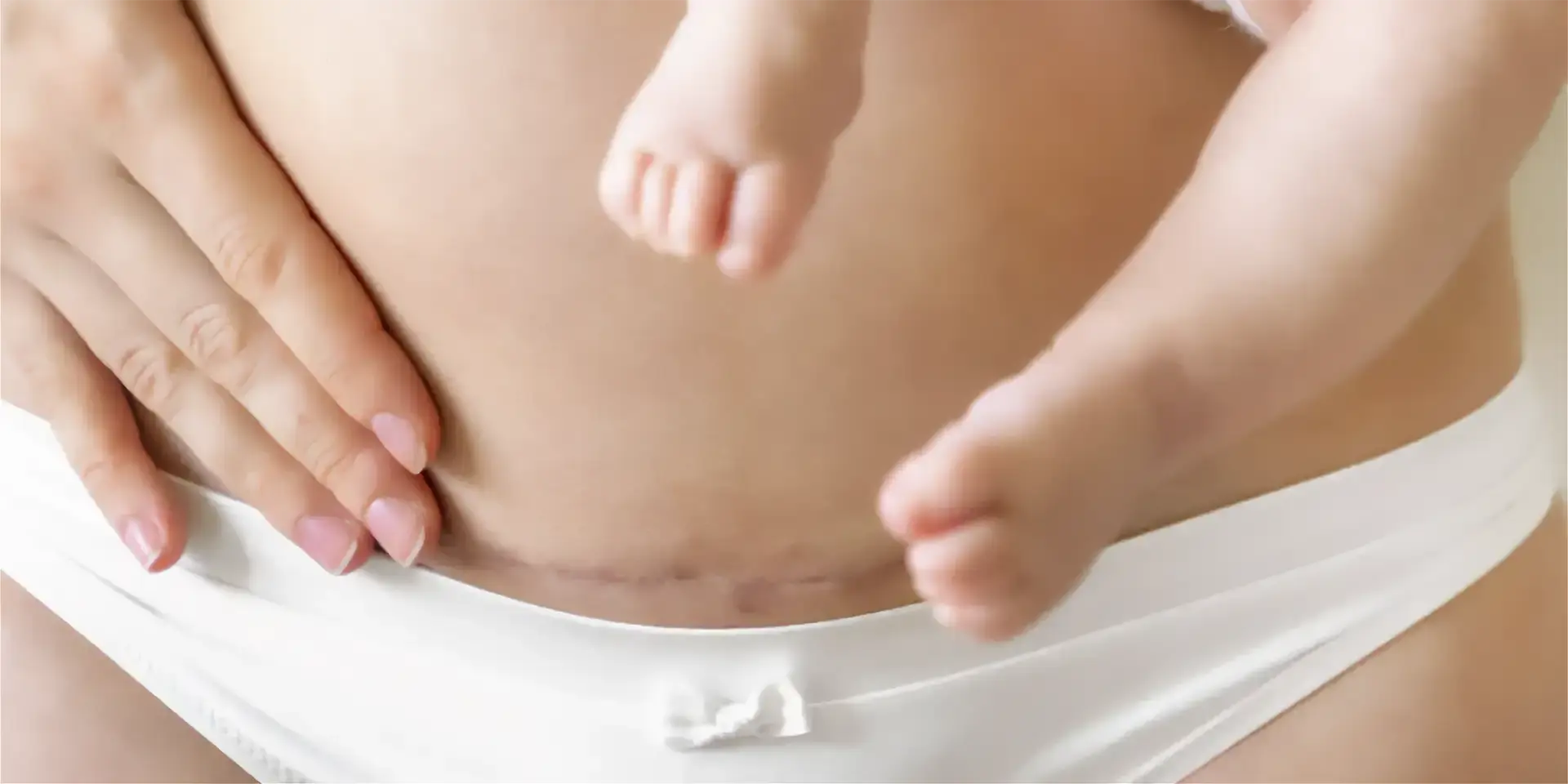 Complete-Guide-to-C-Section-Scar-Recovery-Expert-Tips-for-Healing-and-Minimising-Scarring Genova Skincare