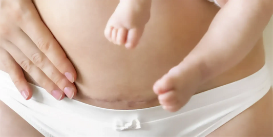 Complete-Guide-to-C-Section-Scar-Recovery-Expert-Tips-for-Healing-and-Minimising-Scarring Genova Skincare
