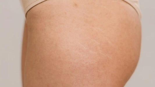 How-to-Get-Rid-of-Stretch-Marks-The-Ultimate-Treatment-Guide-for-2025 Genova Skincare