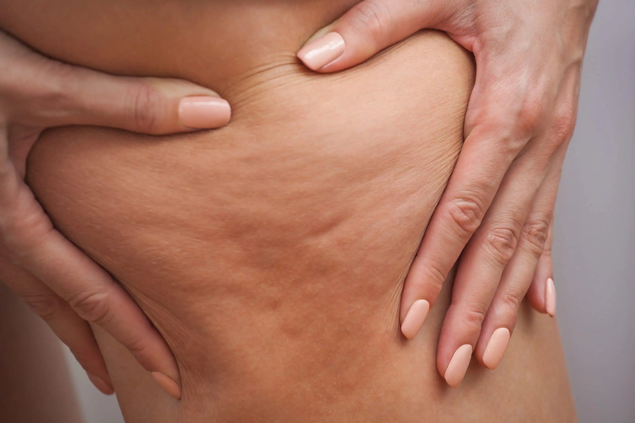 Close-up of cellulite on a woman's thigh