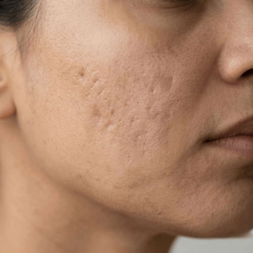 Close-up of acne scarring on the cheek showing pitted and textured skin, a common concern silicone scar gel may help improve
