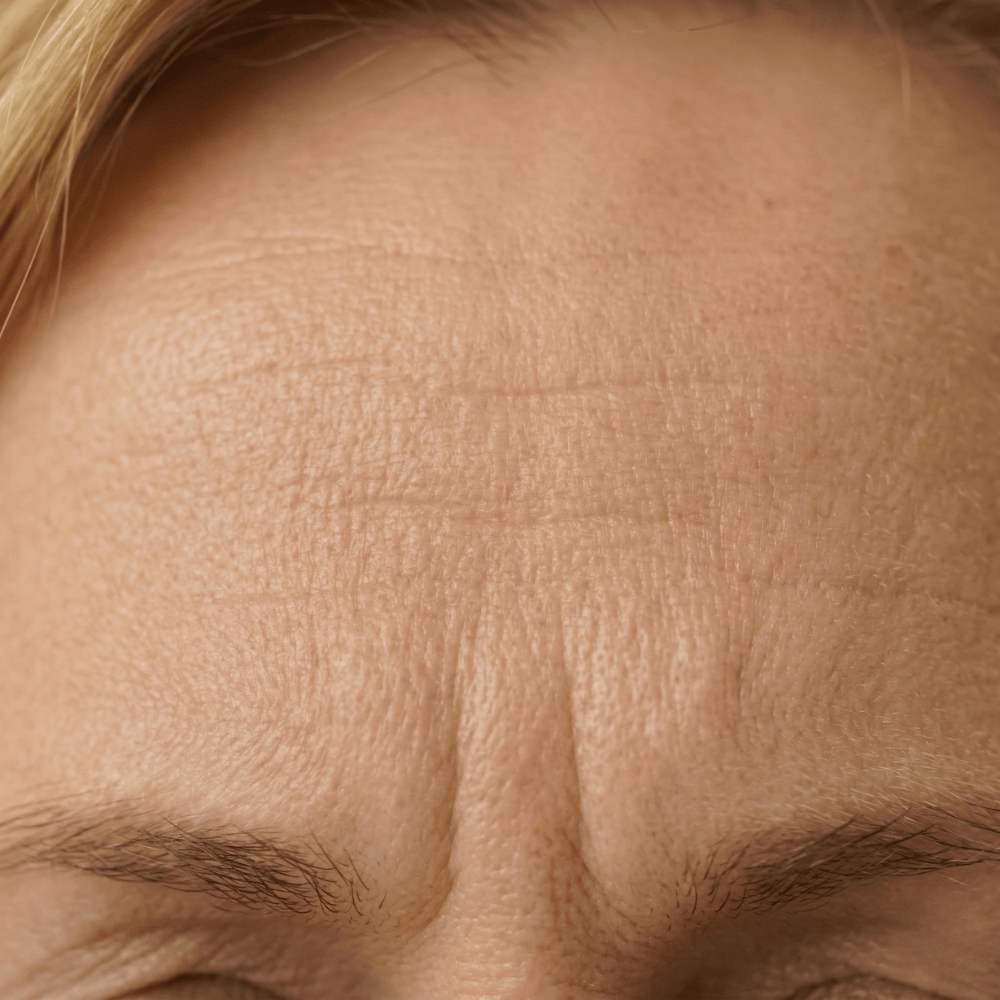 Close-up of deep forehead wrinkles and frown lines on mature skin, a common concern during perimenopause as collagen declines