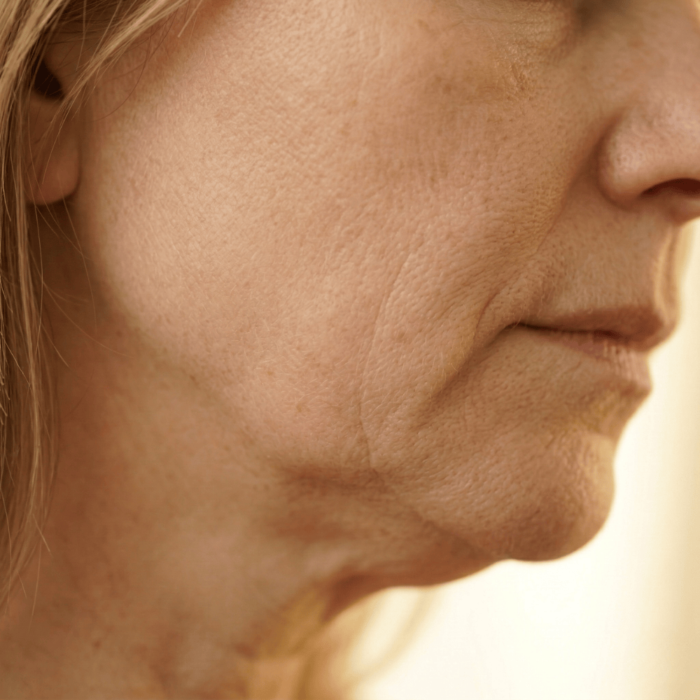 Close-up of deep nasolabial folds and marionette lines on mature skin, expression wrinkles that worsen with estrogen decline during menopause