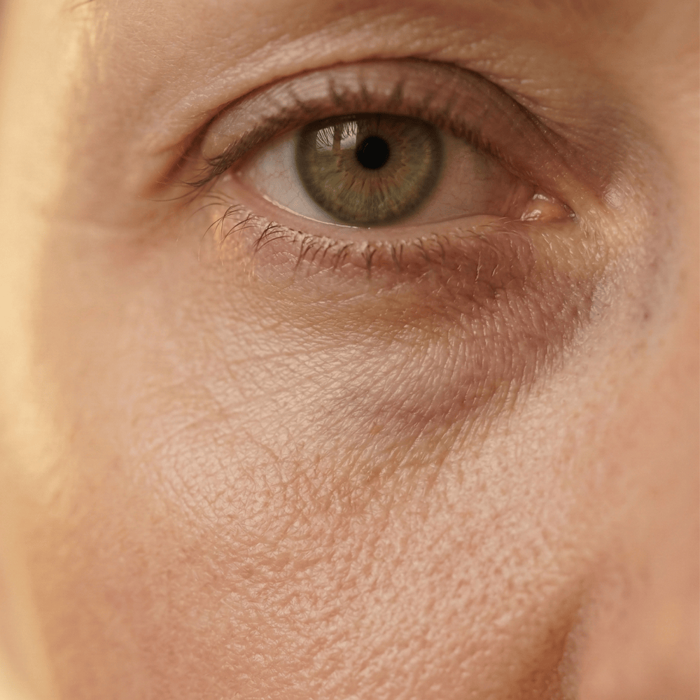 Close-up of dark circles, under-eye hollows and crow's feet on mature skin, signs of thinning skin and reduced circulation during menopause