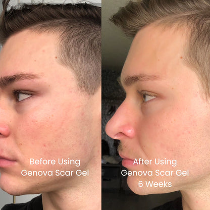 Genova Silicone Scar Gel