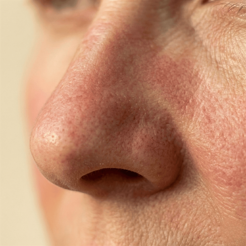 Close-up of redness around the nose and cheeks, showing visible facial flushing often associated with sensitive skin and rosacea-type concerns