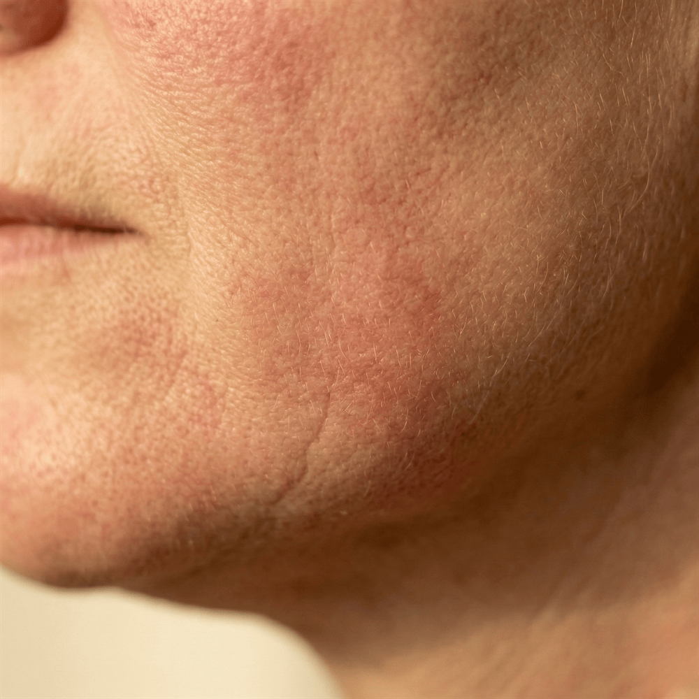 Close-up of persistent redness and irritation on the chin and jawline, a common facial redness concern that may benefit from soothing skincare ingredients