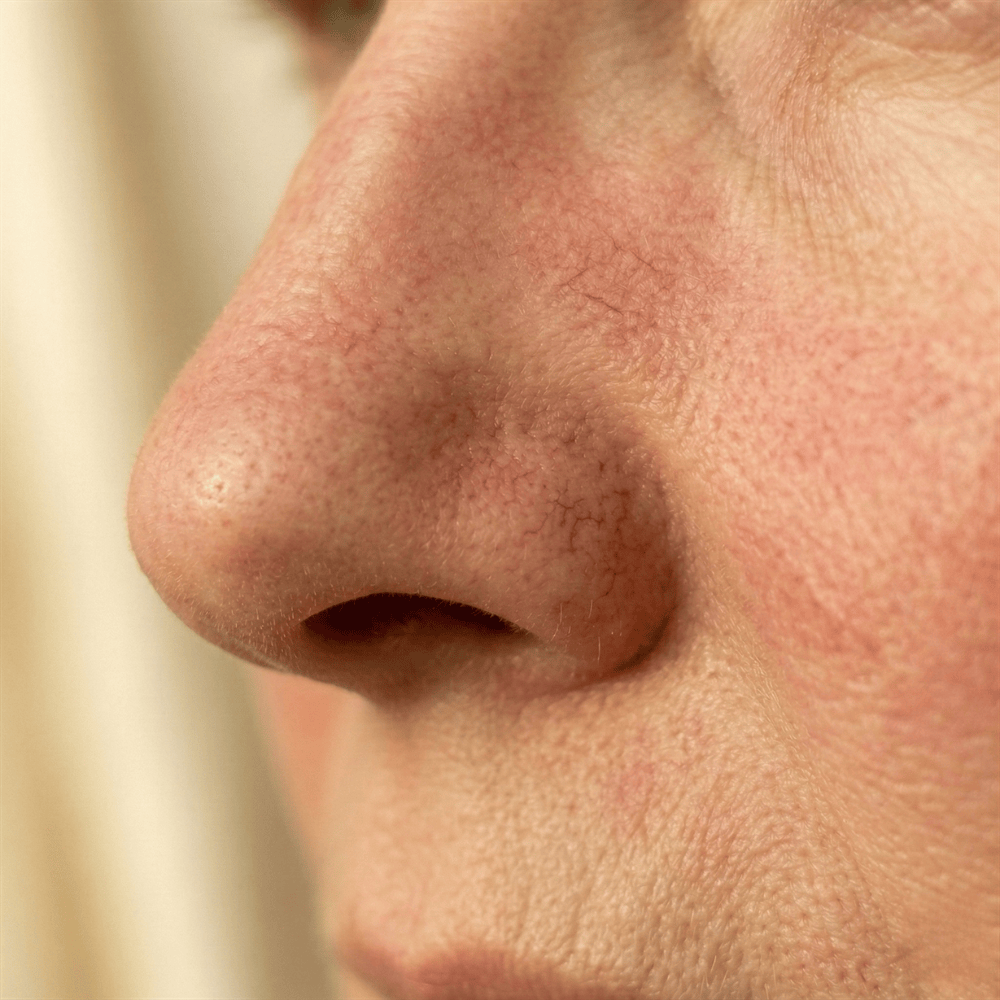 Close-up of visible redness and broken capillaries on the cheek near the nose, showing diffuse facial redness that targeted skincare may help calm over time