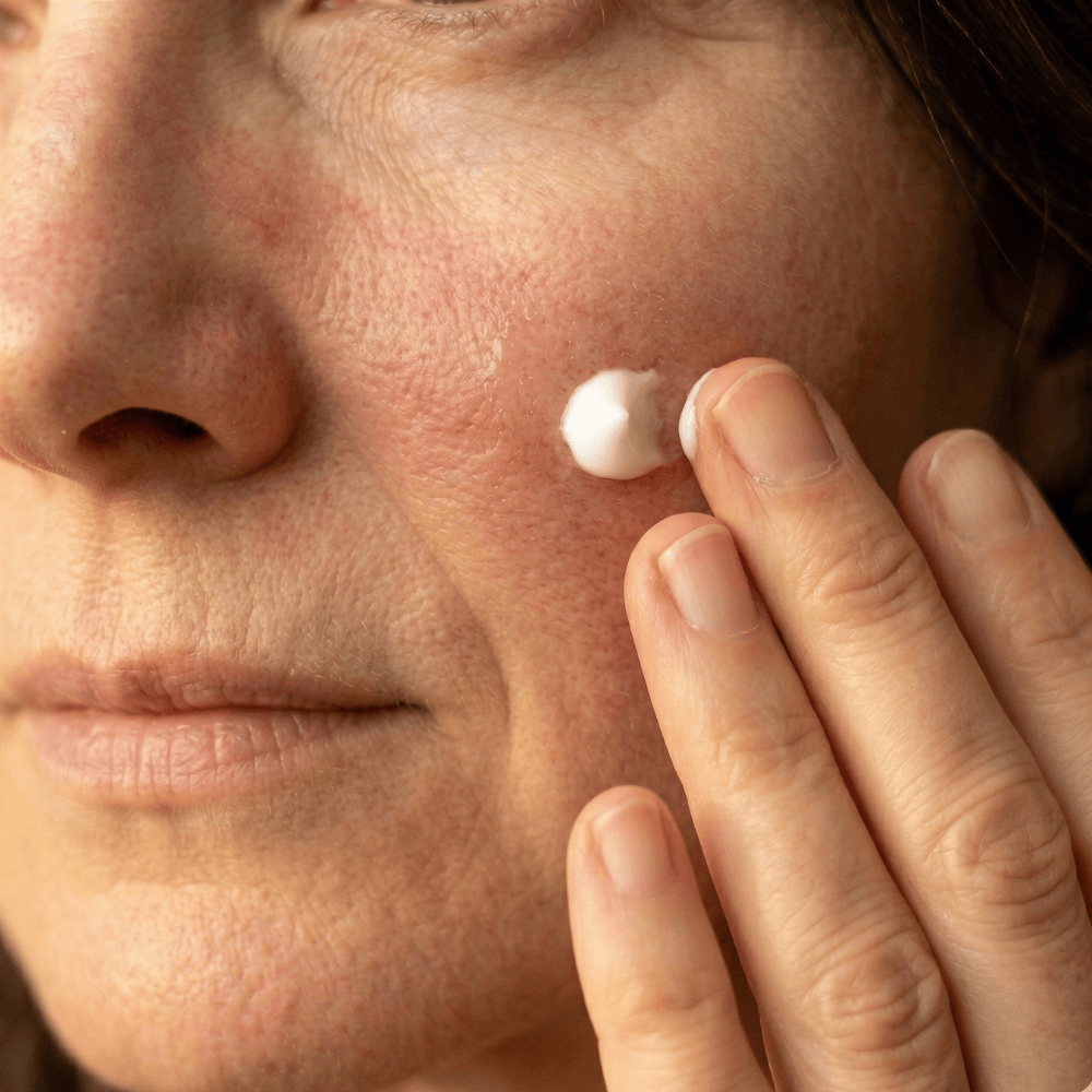 Close-up of applying soothing serum to a red flushed cheek, showing how targeted skincare may help calm visible facial redness and support sensitive skin comfort