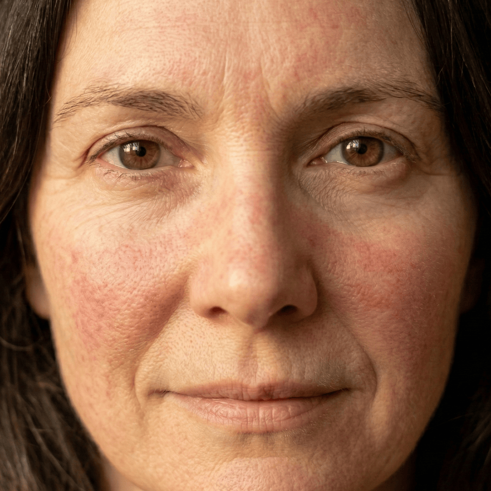 Close-up of a woman's face showing widespread facial redness across both cheeks, the type of persistent redness and uneven skin tone that soothing skincare may help manage