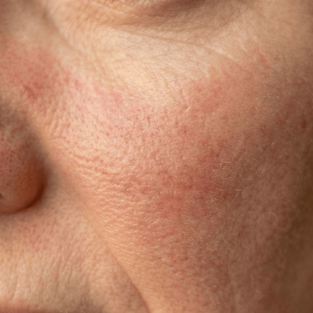 Close-up of dull uneven skin tone on the cheek with visible texture and discolouration, the type of complexion concern brightening skincare may help improve
