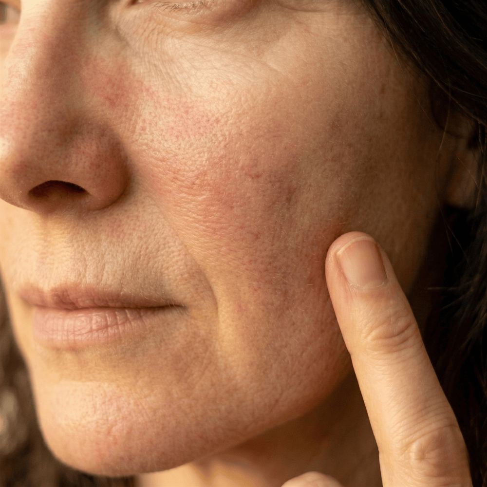 Close-up of dull uneven complexion on the cheek with visible discolouration and loss of radiance, a common menopausal skin concern that brightening serum may help address